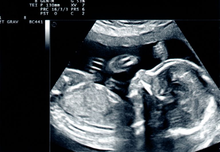 ultrasound scan of baby