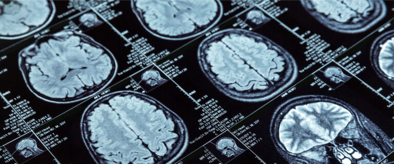 Artificial Intelligence may diagnose dementia in a day